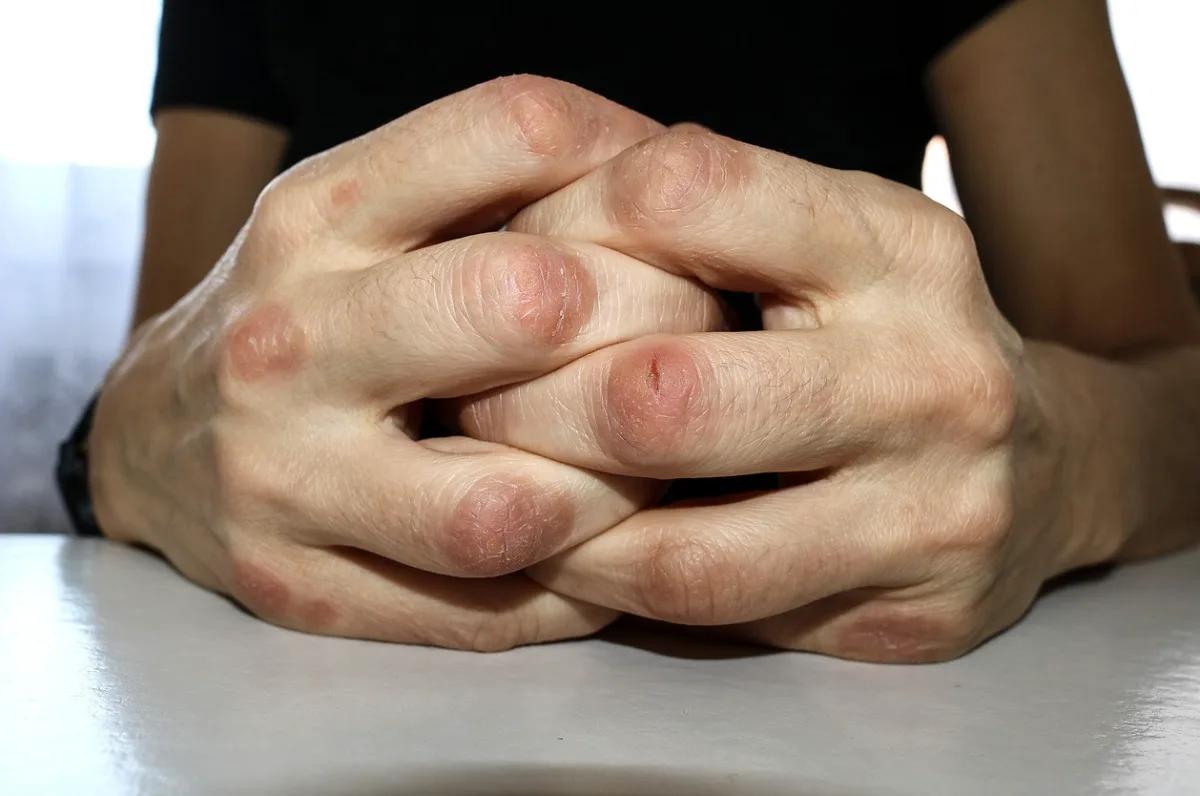 Campaña gratis en el Rawson para detectar psoriasis y artritis psoriásica: cuándo pedir turno