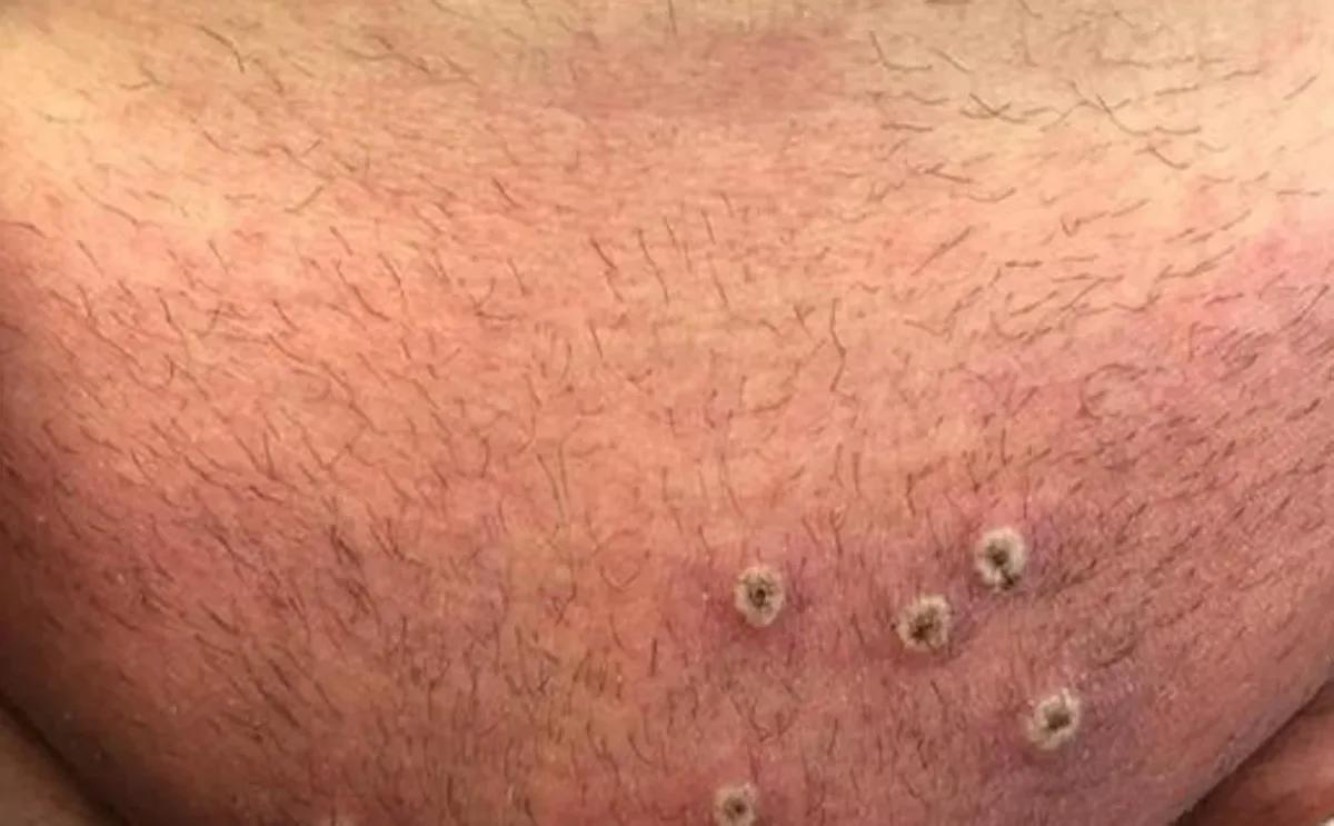 Confirmaron en San Juan un caso de mpox importado y rastrearon a sus contactos
