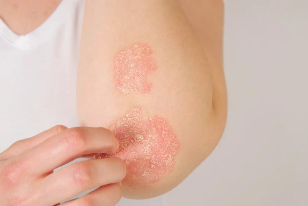 Campaña gratuita en San Juan para detectar psoriasis y artritis psoriásica: cuándo y cómo sacar turno